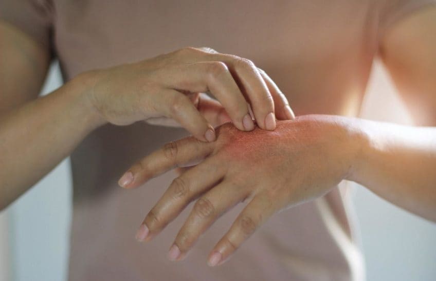 Close up of a woman's hand scratching her other hand which has a visible rash.