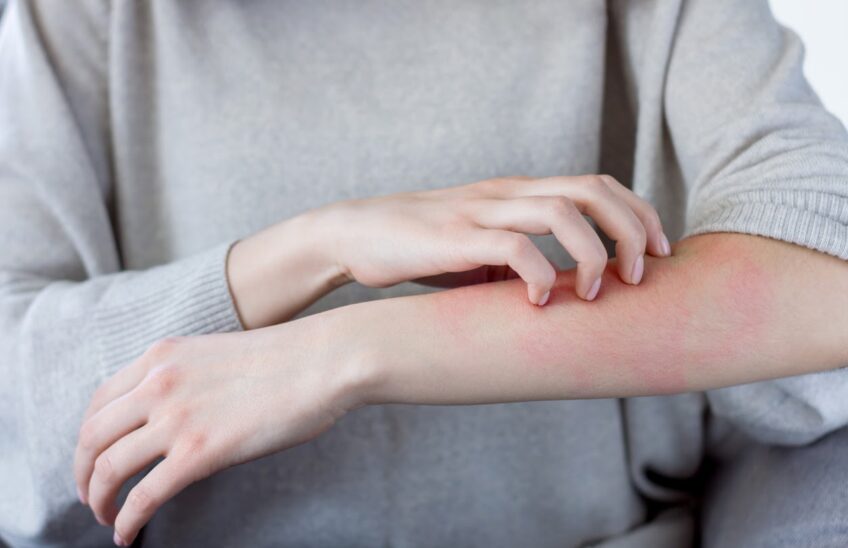 Woman scratching a rash on her arm.