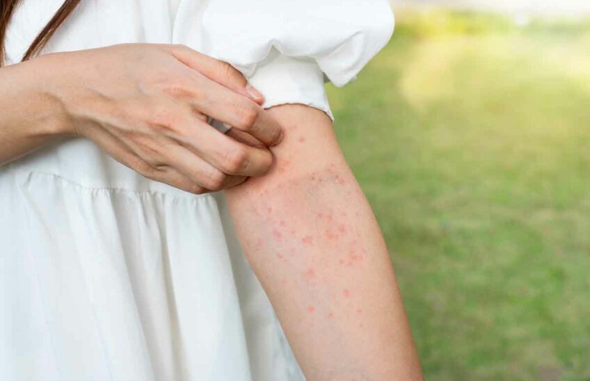 A person scratching a rash on their arm