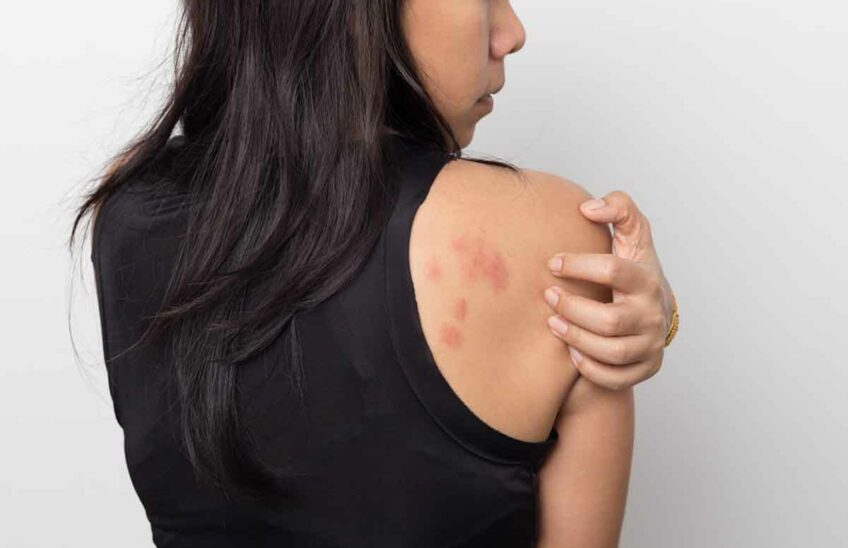 A woman scratching hives on the back of her shoulder